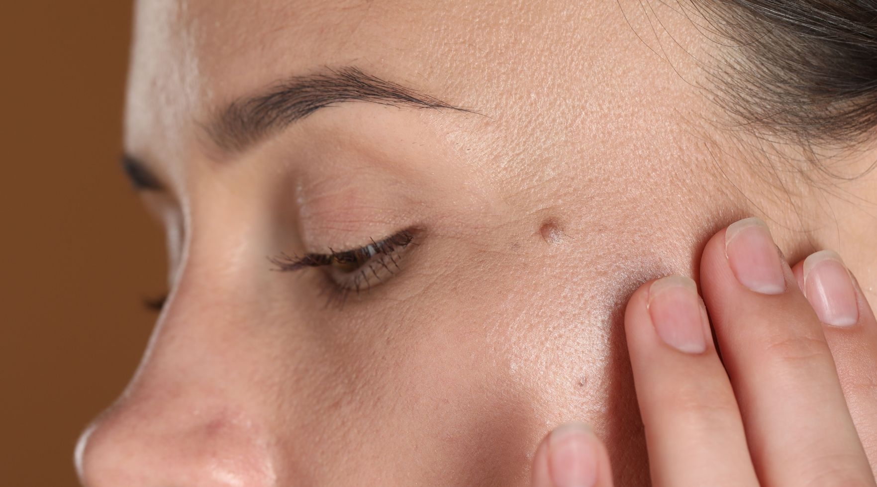 usuwanie pieprzyków