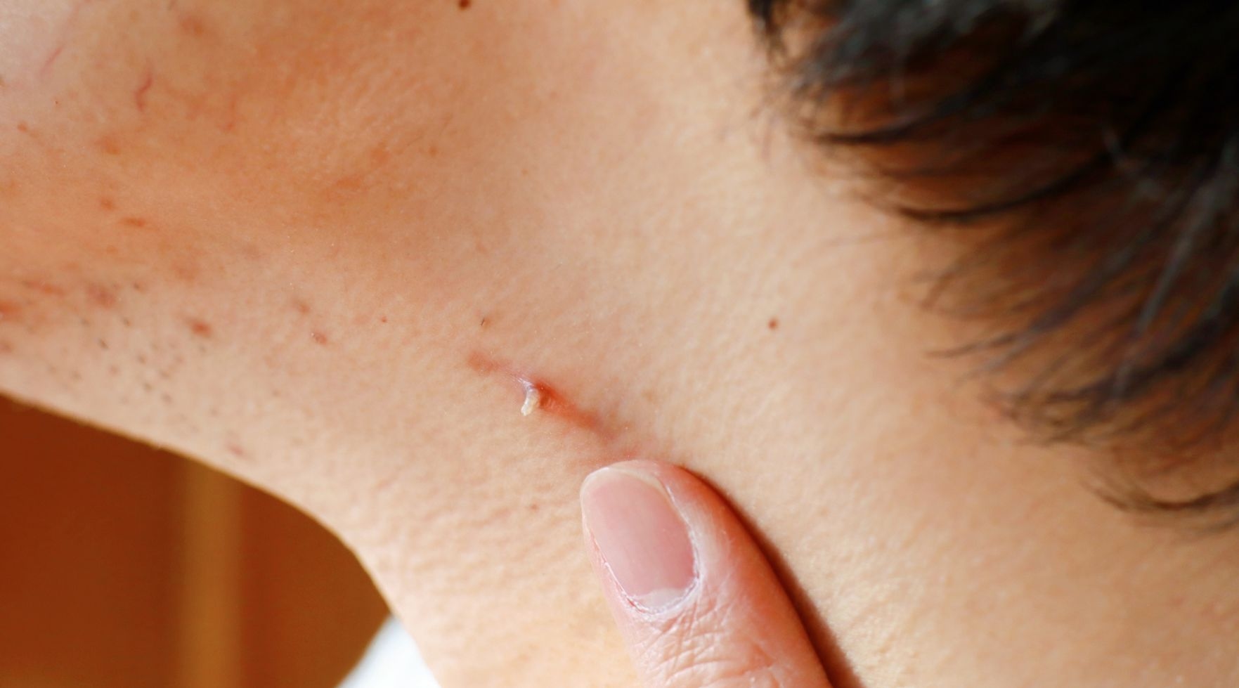 usuwanie brodawek i kurzajek