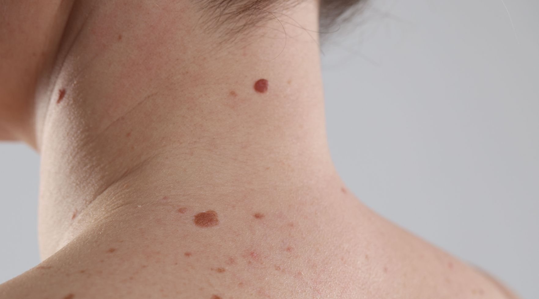 znamiona, które wymagają konsultacji dermatologicznej